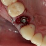 Gesetztes Implantat und aufgefülltes Zahnfach