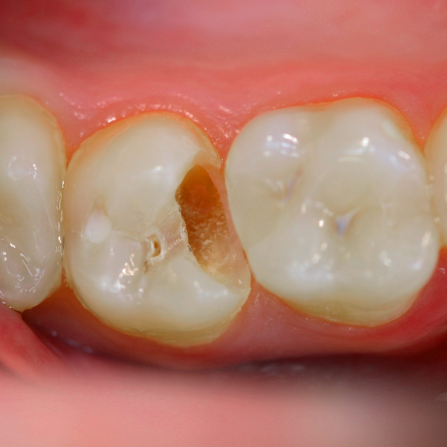 Zahn mit Karies, rausfefallerner Füllung