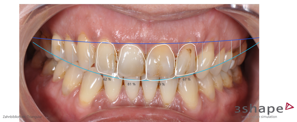 Veneers, Planung mit Smile-Design 2, ZSC-Stuttgart