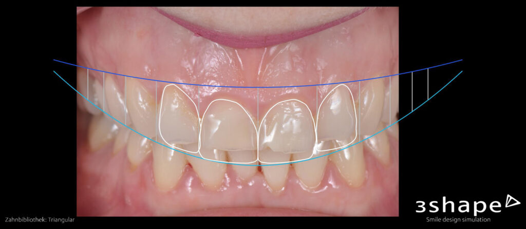 Veneers, Planung mit Smile-Design